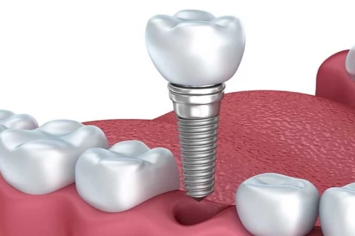 Proteza ili Implantati?